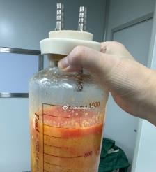 阳春水动力吸脂手术要做多久？